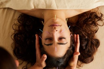 woman getting an acupuncture treatment