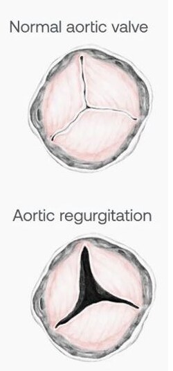 Aortic Regurgitation 